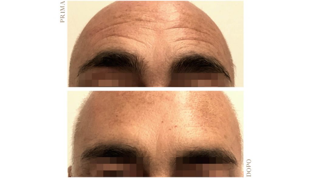 “Brotox”: il trattamento Botox per l’uomo